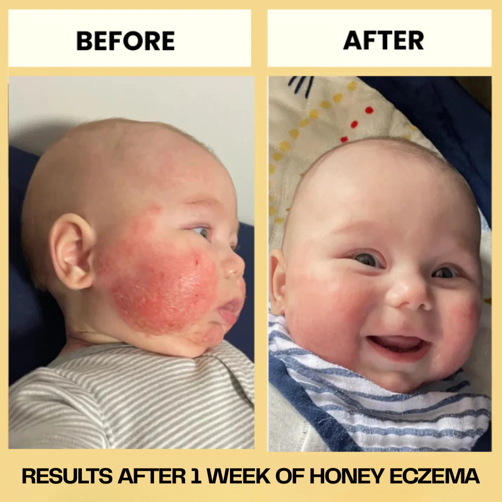 Honey Eczema Soothing Cream 100ML - Soft Relief for Little Ones with Sensitive Skin