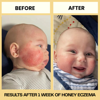 Honey Eczema Soothing Cream 100ML - Soft Relief for Little Ones with Sensitive Skin