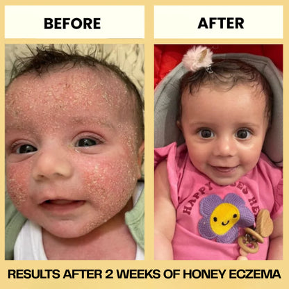 Honey Eczema Soothing Cream 100ML - Soft Relief for Little Ones with Sensitive Skin