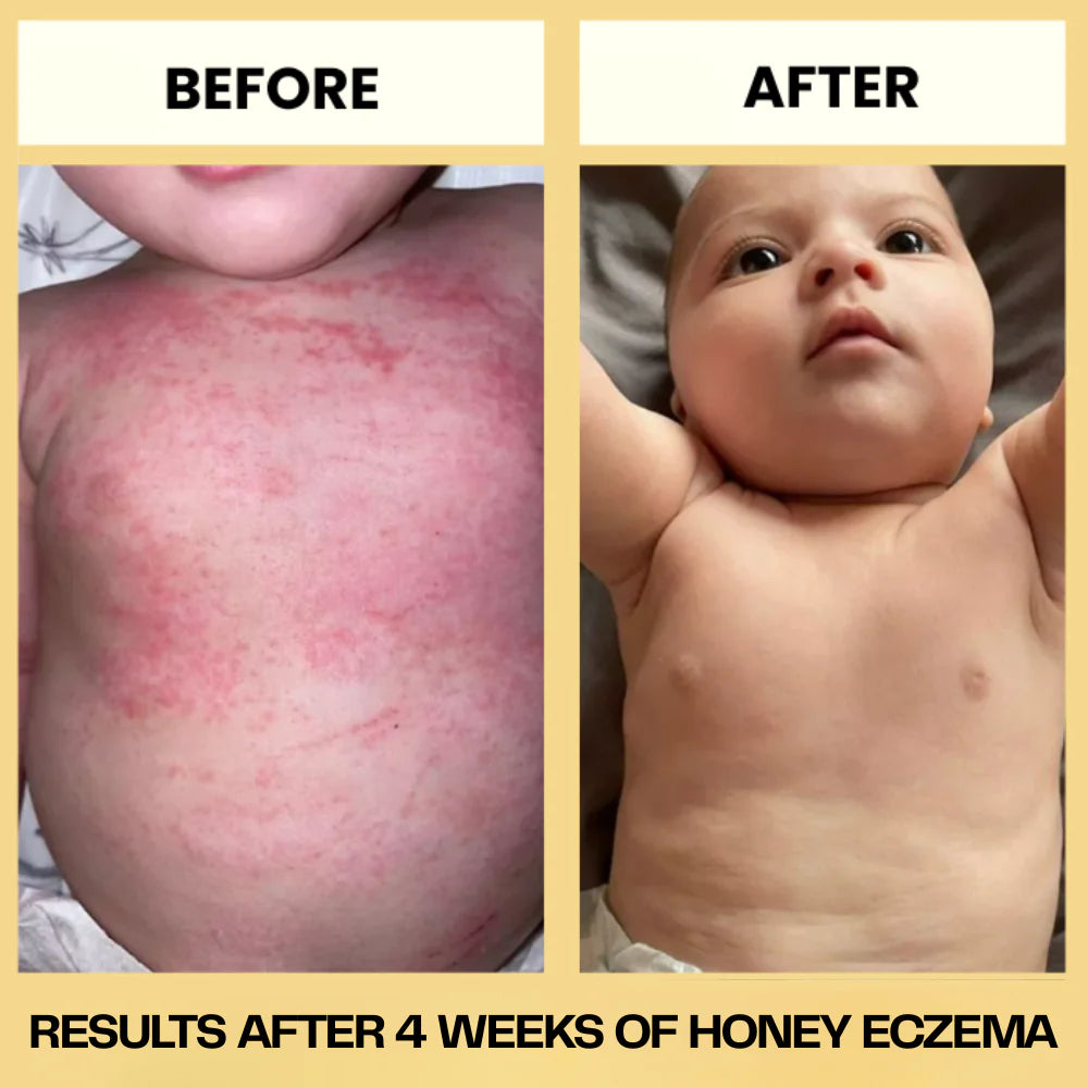Honey Eczema Soothing Cream 100ML - Soft Relief for Little Ones with Sensitive Skin