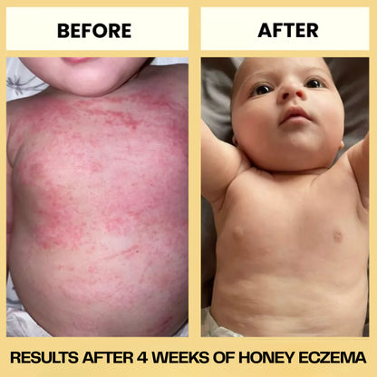 Honey Eczema Soothing Cream 100ML - Soft Relief for Little Ones with Sensitive Skin